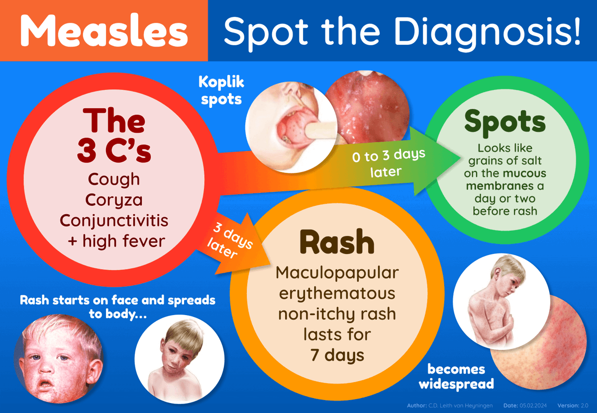 🚨🔍 Quick measles diagnosis is key in managing outbreaks. Our visual guide makes spotting the signs easy: the 3 C's, Koplik spots, and the progression of the rash. Perfect for ED teams and clinicians! Stay informed, stay ahead. 🏥💉 #MeaslesAwareness #PublicHealth #SpotTheSigns
