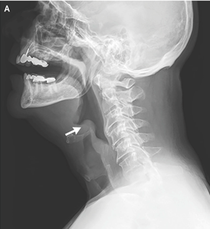 guerreroespejo's tweet photo. 48 años ♂️: odinofagia de 3 días, fiebre con temperaturas de hasta 40 ° C, disnea progresiva y estridor inspiratorio.

RX: "signo del pulgar" (A, flecha), ¿qué sugiere?
1/3

DOI: 10.1056/NEJMicm1816761
#infecciosas #urgencias #radiología https://t.co/epSQQfKIpJ