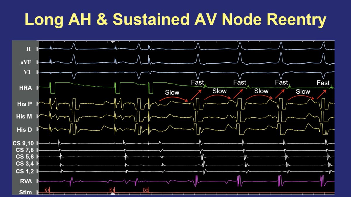 Two components of the AV node. Sides from by Dr. Joshua Cooper