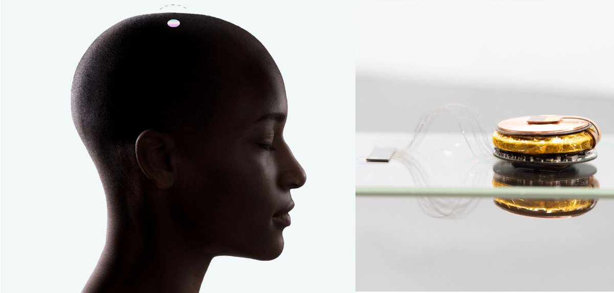 BassonBrain's tweet photo. ‼️ Elon Musk shared an update on Neuralink's first patient's progress ...

“We hope to have results later this week from the first patient. So far, things are looking positive. And I’m hopeful by the end of this week that we’ll be able to report that the first Neuralink patient is able to control a phone and a computer,”

@elonmusk shared the update about @neuralink first patient in a quick interview with Fab TV, Musk revealed his optimism for Neuralink’s first patient in its human trials.