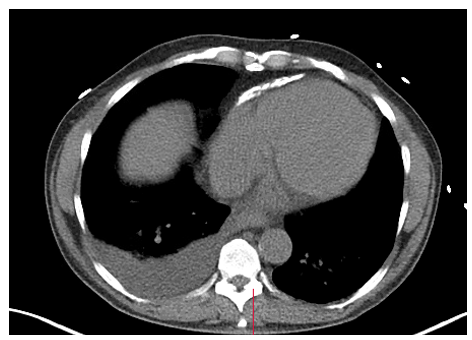 New poll! 66-year-old male with SOB underwent cardiac PET MPI prior to renal transplant. What diagnosis should be considered? Check out his images & vote below. @JNCjournal @PETpartnership @BCIS_uk @CardioNerds