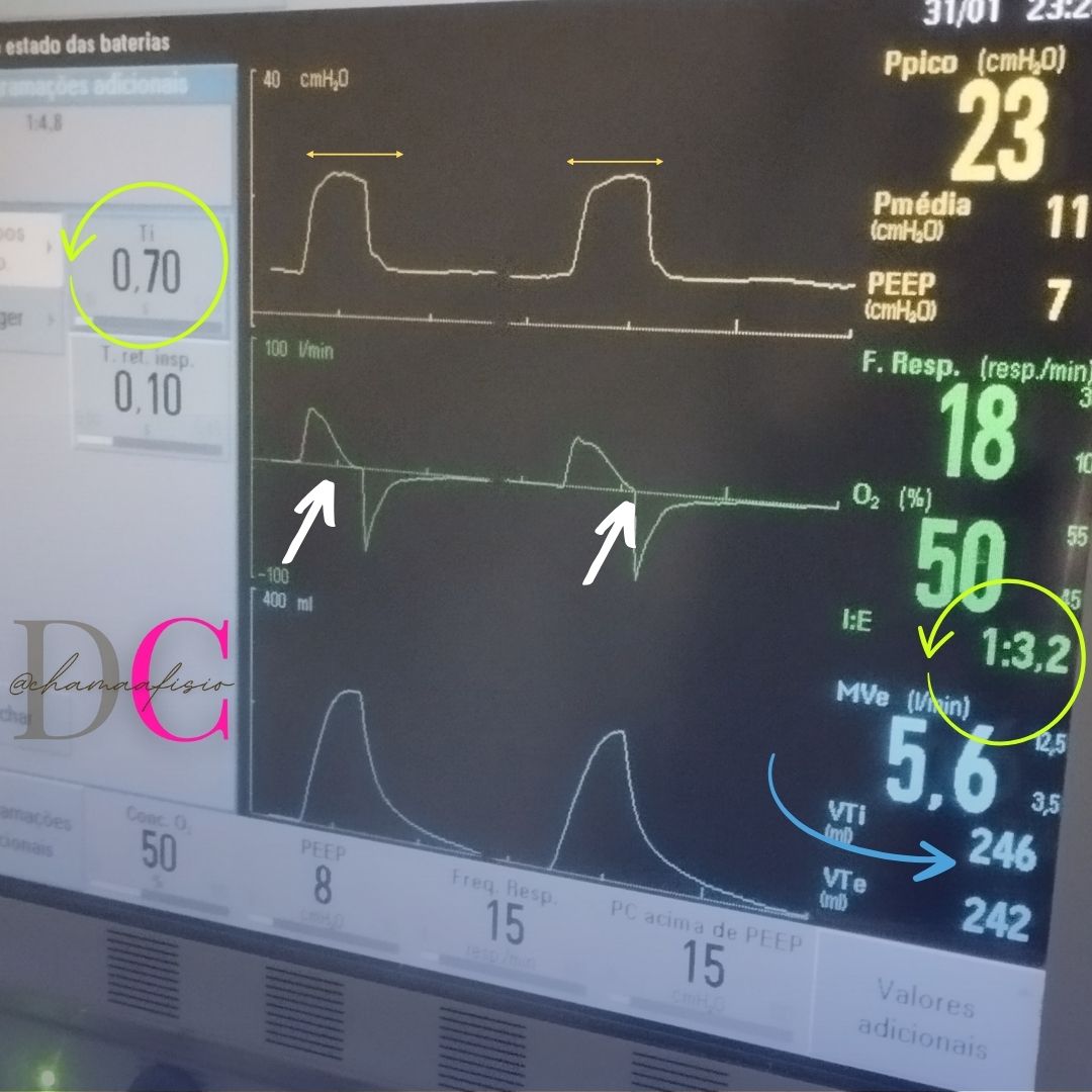 chamaafisio's tweet photo. Ganhando volume corrente com ajuste de tempo inspiratório em modo PCV, sem aumentar a pressão, sem mexer na frequência respiratória. https://t.co/oHsU8z7FMT
