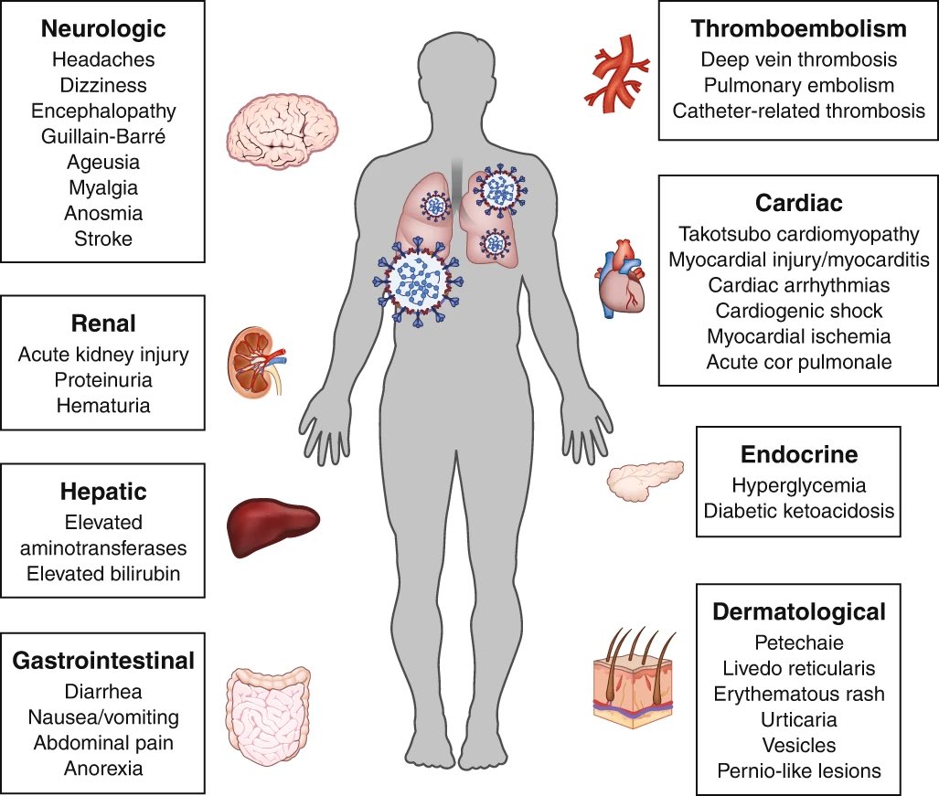 vipintukur's tweet image. COVID-19 is a multisystem disease and is associated with significant respiratory distress, systemic hyper inflammation, vasculitis & multi-organ failures. 1/