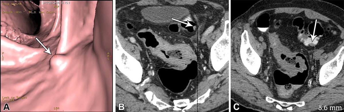 Radiology (@radiology_rsna) on Twitter photo C-RADS v2023 introduces a new subcategory, C2b, for likely benign mass-like diverticular strictures and merges categories E1 and E2 for extracolonic findings not requiring follow-up. <a href="/MontefioreNYC/">Montefiore Health System</a> <a href="/EinsteinMed/">Albert Einstein College of Medicine - Official</a> <a href="/BURadiology/">BU Radiology</a> @theBMC bit.ly/3vTAmFQ C-RADS v2023 introduces a new subcategory, C2b, for likely benign mass-like diverticular strictures and merges categories E1 and E2 for extracolonic findings not requiring follow-up. <a href="/MontefioreNYC/">Montefiore Health System</a> <a href="/EinsteinMed/">Albert Einstein College of Medicine - Official</a> <a href="/BURadiology/">BU Radiology</a> @theBMC bit.ly/3vTAmFQ