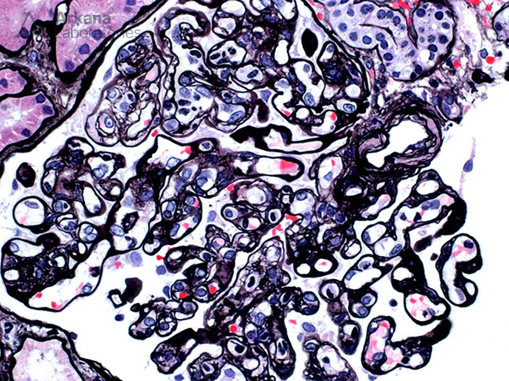 Time for another #DiagnoseThis! 

What is your diagnosis in this transplant biopsy given the features present?

#RenalPath #Renal