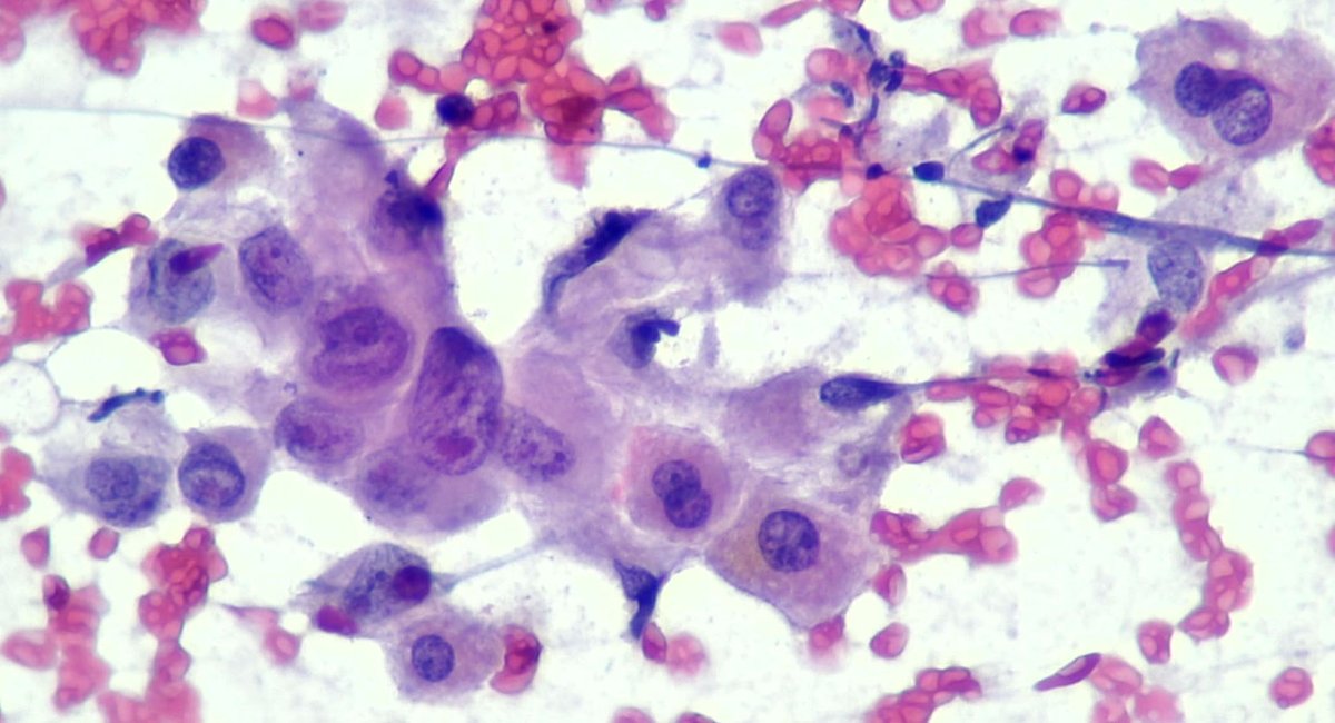 Lola Lozano (@mdlozanoe) on Twitter photo In a minority :( And in a bad company 🔬😧👻.
Liver mets of a PDAC <a href="/EfcsYoung/">Young EFCS</a> <a href="/SECitologia/">Sociedad Española de Citología</a> <a href="/glinglerimek/">gulcin guler simsek, MD</a> <a href="/Quique_rs/">Quique Revilla</a> In a minority :( And in a bad company 🔬😧👻.
Liver mets of a PDAC <a href="/EfcsYoung/">Young EFCS</a> <a href="/SECitologia/">Sociedad Española de Citología</a> <a href="/glinglerimek/">gulcin guler simsek, MD</a> <a href="/Quique_rs/">Quique Revilla</a>