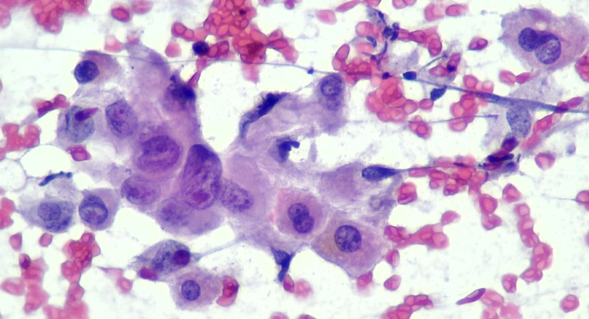 In a minority :( And in a bad company 🔬😧👻. Liver mets of a PDAC @EfcsYoung @SECitologia @glinglerimek @Quique_rs