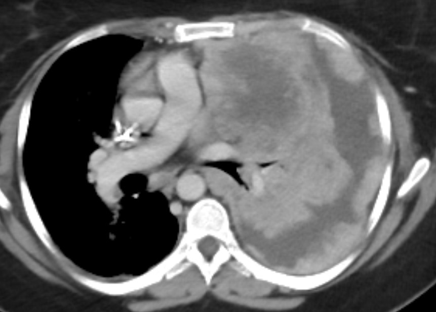 ✅ When pathology allows you to perfectly identify pleural layers 😎

🟣🟠 Necrotic pulmonary mass
🟢 Visceral pleura
🔵 Parietal pleura
🟡 Pleural effusion

#juniorradres #radiology #medicine #FOAMrad #FOAMed #anatomy