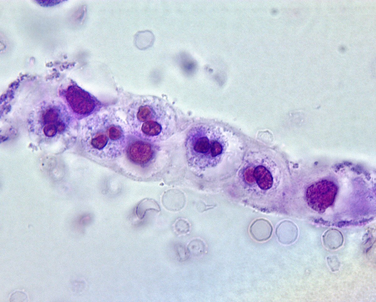 1/4 SLE, AKI. RBC casts, WBC (neutrophils) casts and mixed RBC/WBC (dark field) casts, consistent with GN. #UrinarySediment #UrineMicroscopy @OchsnerNephro