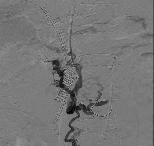 Catheter and wire from IVC into cavernoma after transabdominal creation of access