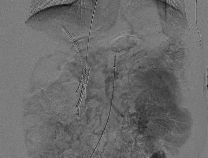 Delayed SMA angiogram showing extensive PMT