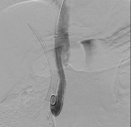 Post shunt placement venogram after 6 weeks showing brisk flow through shunt