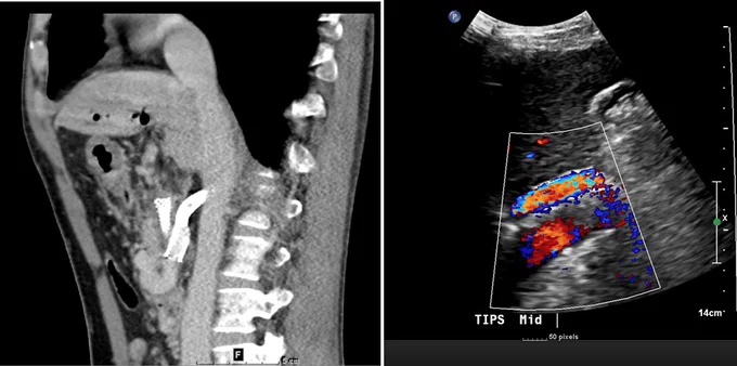 CT and US showing patent shunt after 1 year
