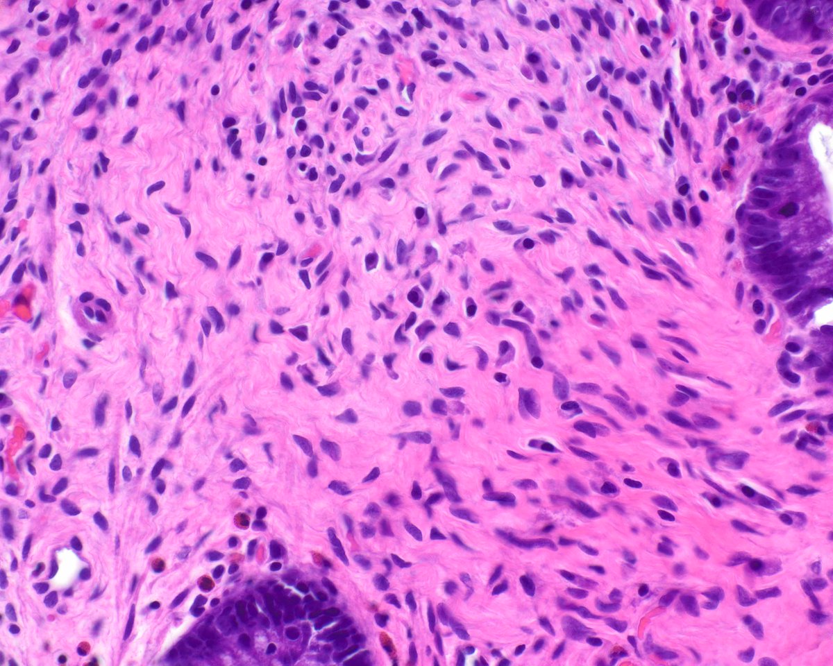 science_press's tweet photo. Another colonic perineurioma associated with a hyperplastic polyp.  These were termed "benign fibroblastic of the colon" initially until perineural differentiation was detected. https://t.co/smaPir30f5 https://t.co/EygLpn9Yf8