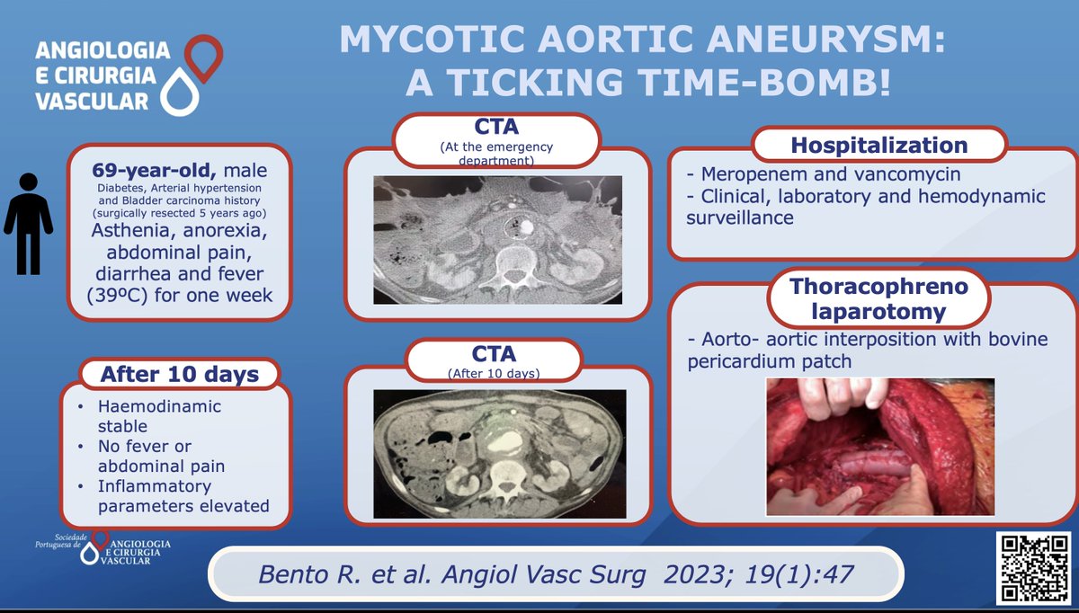Open surgery and an aorto- aortic interposition with bovine pericardium patch was the treatment choice of Bento R. et al.
Read more here: acvjournal.com/index.php/acv/…
#spacv #vascularsurgery #mycoticaorticaneurysms #vascularinfections 

<a href="/ESVSmembership/">ESVS</a> 
<a href="/VascularSVS/">Society for Vascular Surgery</a> 
<a href="/VascularNews/">Vascular News</a>