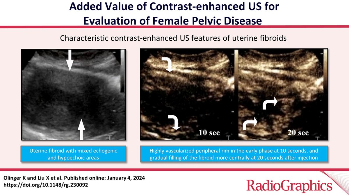 Contrast-enhanced US is a valuable tool in evaluation of female pelvic disease and can add significant value in gynecologic imaging, and the indications are evolving. bit.ly/3UuQ9Fs @DrKOlinger @XiaoyangLiu18 @imagingtoronto @PKhoshpouri