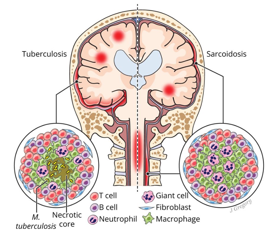 Tuberculous Meningitis or #Neurosarcoidosis—a Diagnostic Quandary: From the National Multiple Sclerosis Society Case Conference Proceedings: bit.ly/3TG7LO9 Illustration by Jill K. Gregory, CMI, licensed under CC BY-NC-ND. #NeuroTwitter