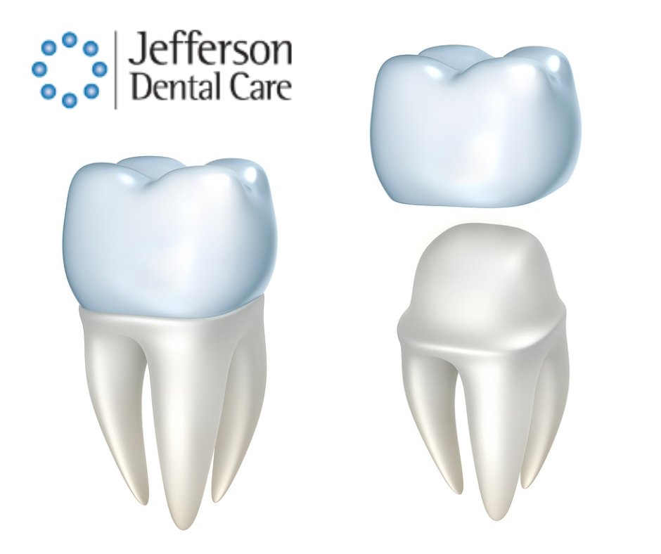 CareJefferson's tweet photo. A single damaged or lost tooth can change the shape of your smile. If you have ever considered dental crowns as a treatment option, you can trust in Jefferson Dental Care. Our team provides long lasting solutions for restoring teeth and smiles. https://t.co/36inP9KoIG