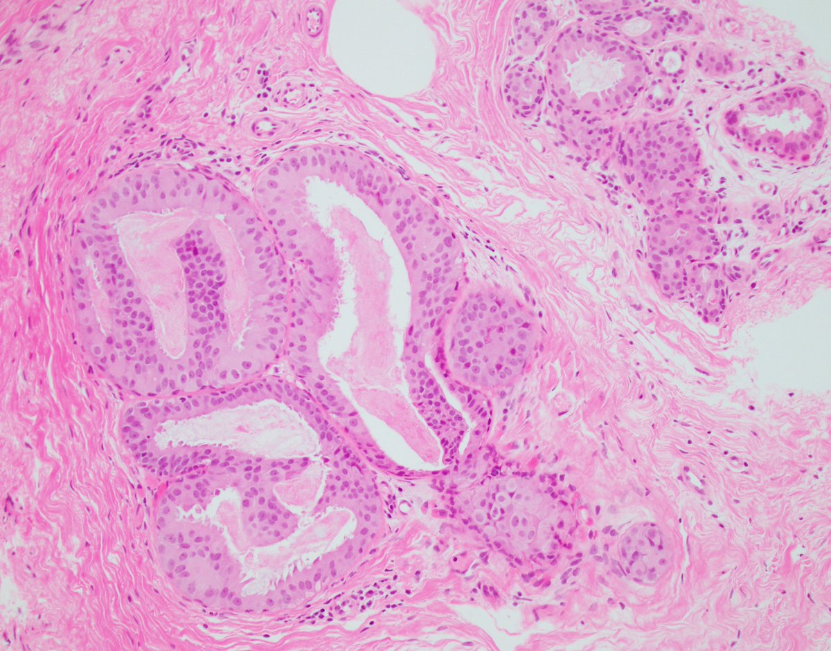 Single focus in a single core from the breast of a 45-year-old woman.

Thoughts?

@wusm_pathology <a href="/washupathedu/">WashU Medicine Pathology & Immunology Education</a> #breastpath #PathTwitter #PathX
