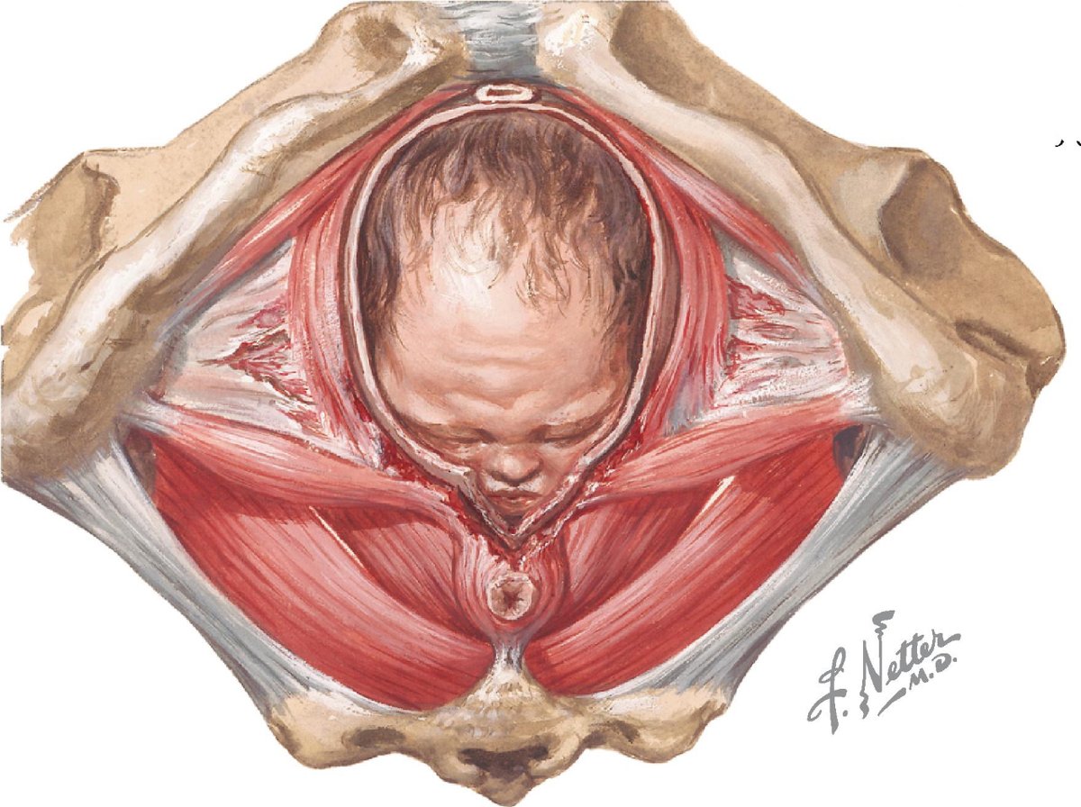 Durante el #parto se puede desgarrar parte de la musculatura del #SueloPélvico y dar lugar a #IncontinenciaFecal, lo que dará lugar a pérdidas de heces.
📚 Netter. Anatomía básica por sistemas © 2023