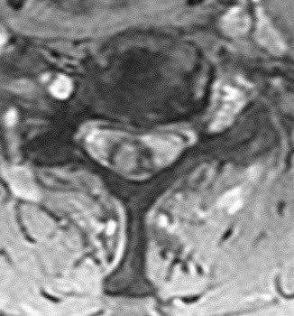 🔷Typical Spinal Ependymomas:

▶️More common in ADULTS & NF2
▶️More WELL DEFINED margins
▶️CENTRAL location expanding outward (since they arise from the ependymal lining along the central canal of the spinal cord)
▶️Polar cysts and HEMOSIDERIN CAP SIGN