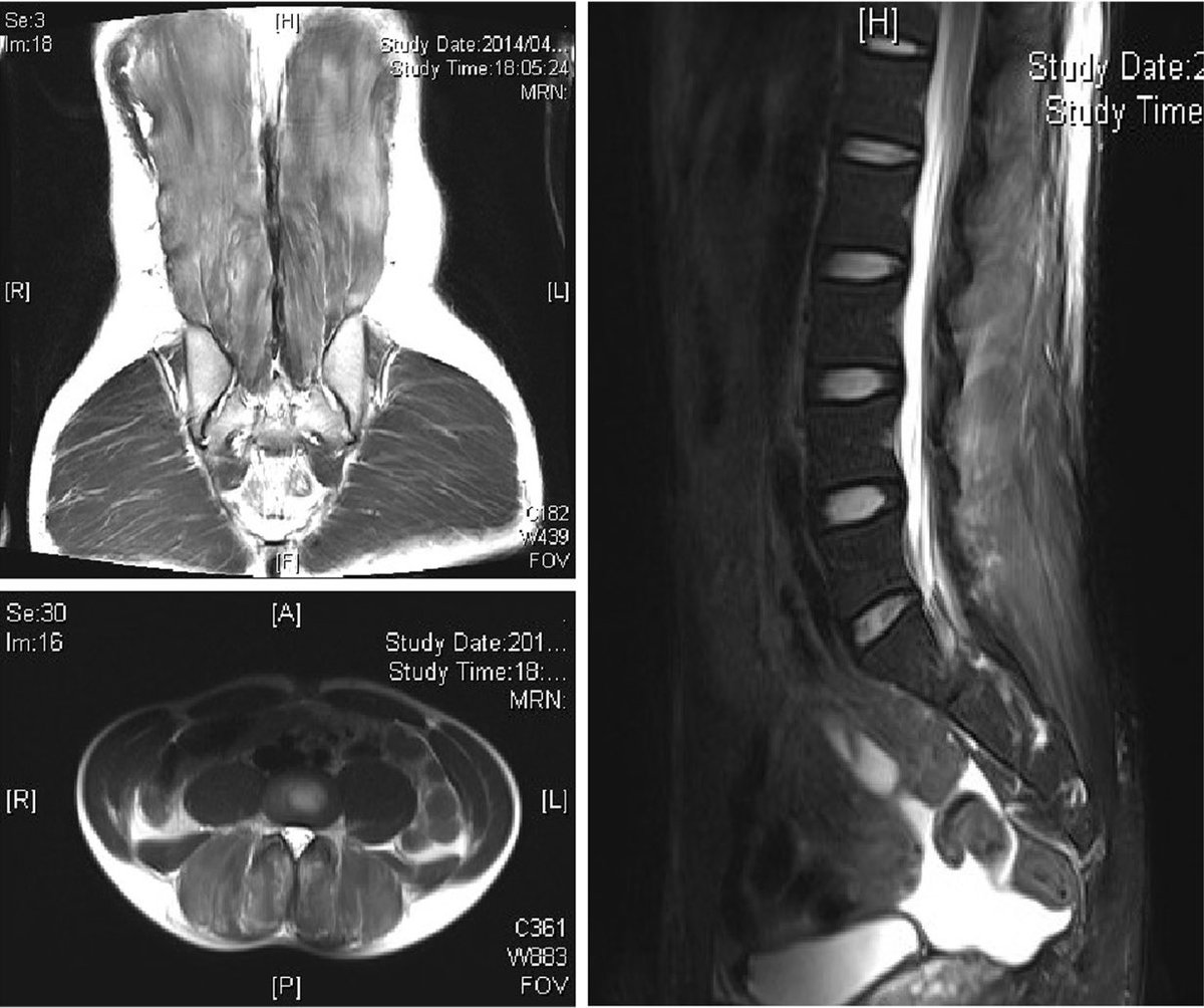 27 year old male presented with sever low back pain after strenuous exercise session including weight lifting. On exam, local tenderness was noted over paraspinal muscles and numbness in the area. No motor or other deficits.
What’s the next step in management ⁉️