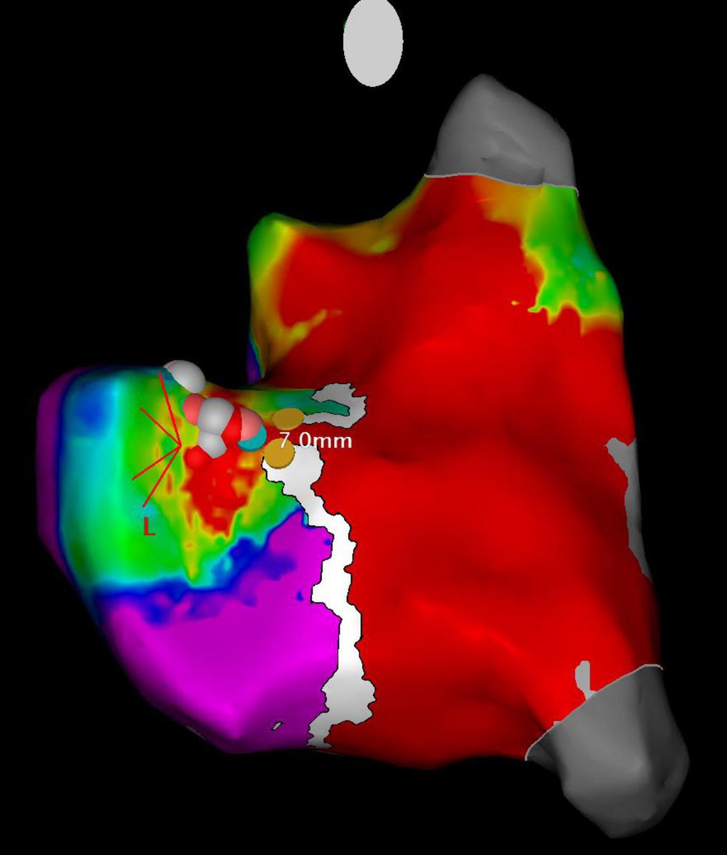 DrHusainShabeeh's tweet image. #EPeeps Young patient with #WPW with Parahisian accessory pathway 😮. Fast antegrade conduction &amp;lt;240ms. Successful ablation just beyond the blue dot (yellow dots are His) @BiosenseWebster @iainparsons