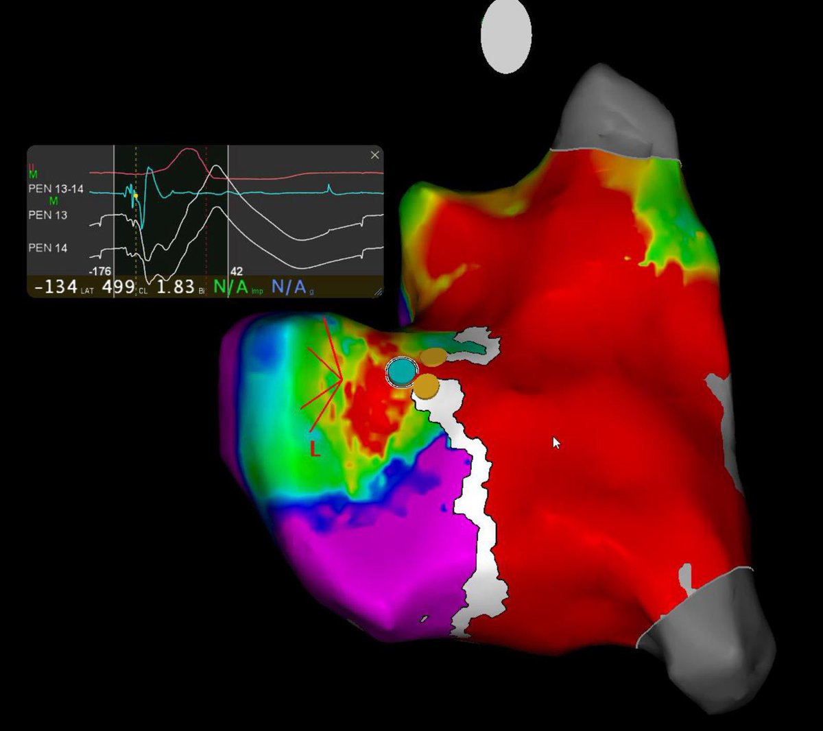 DrHusainShabeeh's tweet image. #EPeeps Young patient with #WPW with Parahisian accessory pathway 😮. Fast antegrade conduction &amp;lt;240ms. Successful ablation just beyond the blue dot (yellow dots are His) @BiosenseWebster @iainparsons