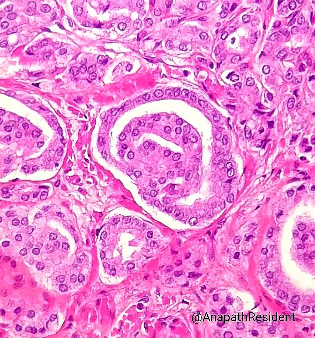 A_Morini_MD's tweet photo. #CharlesIII a une "forme de #cancer".
Un #pathologiste 👨‍⚕️🔬 a donc fait son job, lors d'une résection de #prostate pour hypertrophie en regardant les échantillons qu'il a reçu et a fait le diagnostic d'un adénocarcinome prostatique ...
Les #pathologistes veillent sur vous! 🤔 https://t.co/gVDxYZ12hE