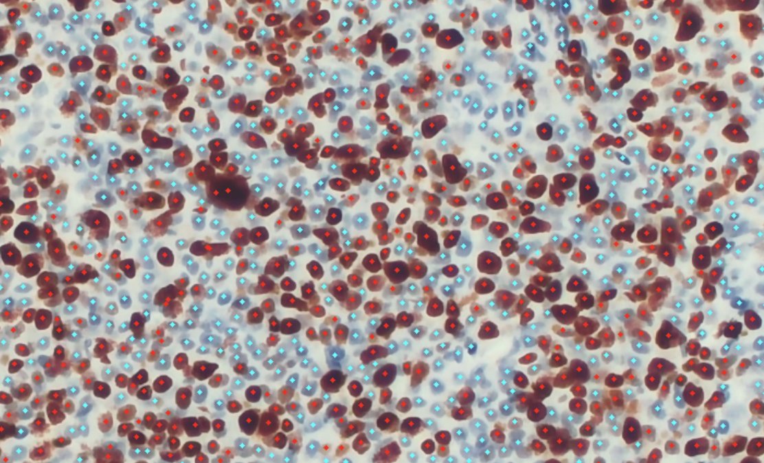 IHCExpert, the free online Ki-67 counter, is now updated with a customizable AI-based slider to accommodate a wider variety of stains from different labs. Try it out: ihcexpert.com #pathtwitter #pathology #ArtificialIntelligence