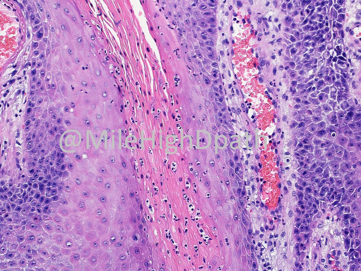 34 y/o. Papule on scrotum. 'R/O condyloma.' No other history known. What is the best diagnosis? A. Condyloma acuminatum B. Condyloma lata C. Epidermolytic hyperkeratosis of the genitalia D. Verruciform xanthoma #Dermpathquiz,#Dermquiz