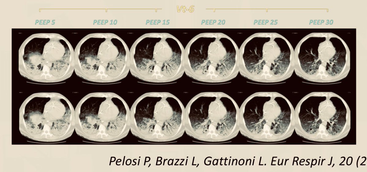 Ventilación en prono para pacientes con SDRA… ¿complicado?… este y otros temas son revisados en el Diplomado en Kinesiología Intensiva del Colegio de Kinesiólogos.
Inicio: 23 de marzo 2024
Mail: info@kineintensiva.cl