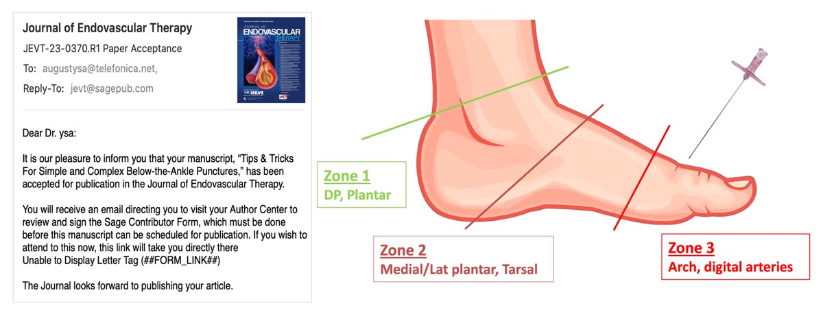 We are really grateful and thrilled for the final acceptance of our paper "TIPS &amp; TRICKS FOR SIMPLE AND COMPLEX BTA PUNCTURES". 
Very soon in the JEVT
<a href="/Vascupedia_com/">Vascupedia</a> <a href="/_backtable/">BackTable Vascular and Interventional</a> <a href="/CLI_Global/">CLI Global Society</a>