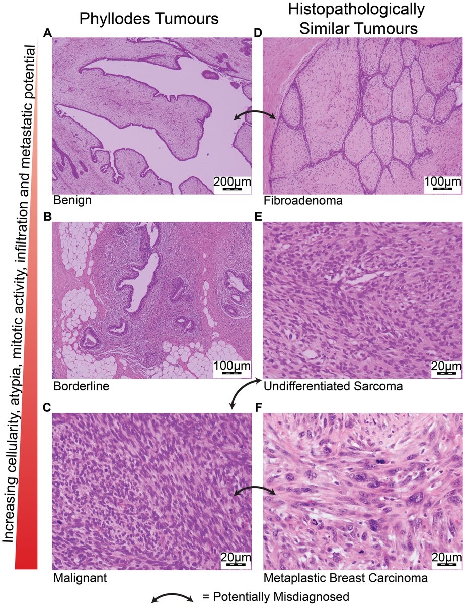 Ruth Pidsley (@ruthpidsley) on Twitter photo Incredibly proud to share our team's work - digging into the DNA methylome of phyllodes tumours to unearth promising diagnostic and prognostic markers for this rare type of breast tumour twtr.to/DNuHb
#epigeneticbiomarkers #precisiononcology <a href="/GarvanInstitute/">Garvan Institute of Medical Research</a> <a href="/pathsoc/">Pathological Society</a> Incredibly proud to share our team's work - digging into the DNA methylome of phyllodes tumours to unearth promising diagnostic and prognostic markers for this rare type of breast tumour twtr.to/DNuHb
#epigeneticbiomarkers #precisiononcology <a href="/GarvanInstitute/">Garvan Institute of Medical Research</a> <a href="/pathsoc/">Pathological Society</a>