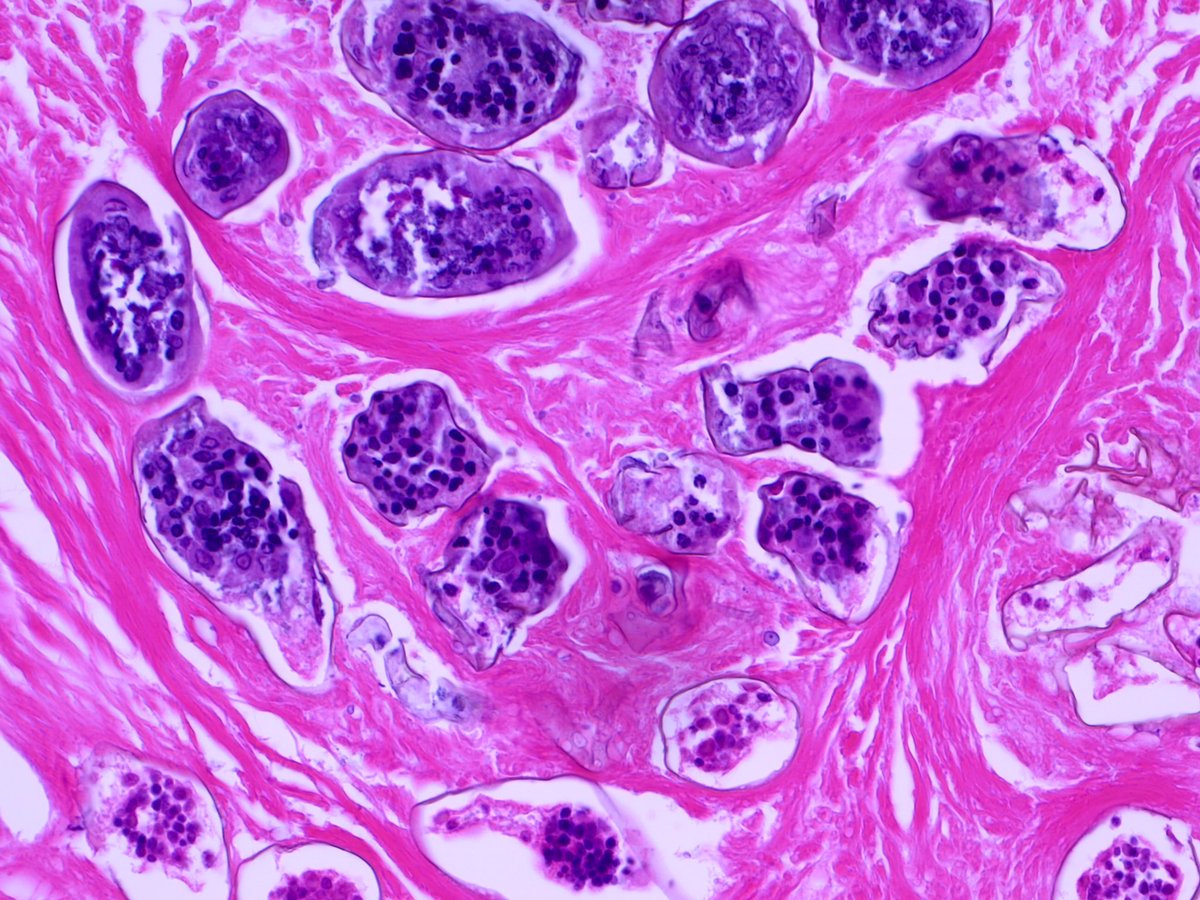 #GIPath #Surgpath #pathresidents 50-ish year old man found to have an incidental enlarged appendix - question neoplasm. What do you guys think?