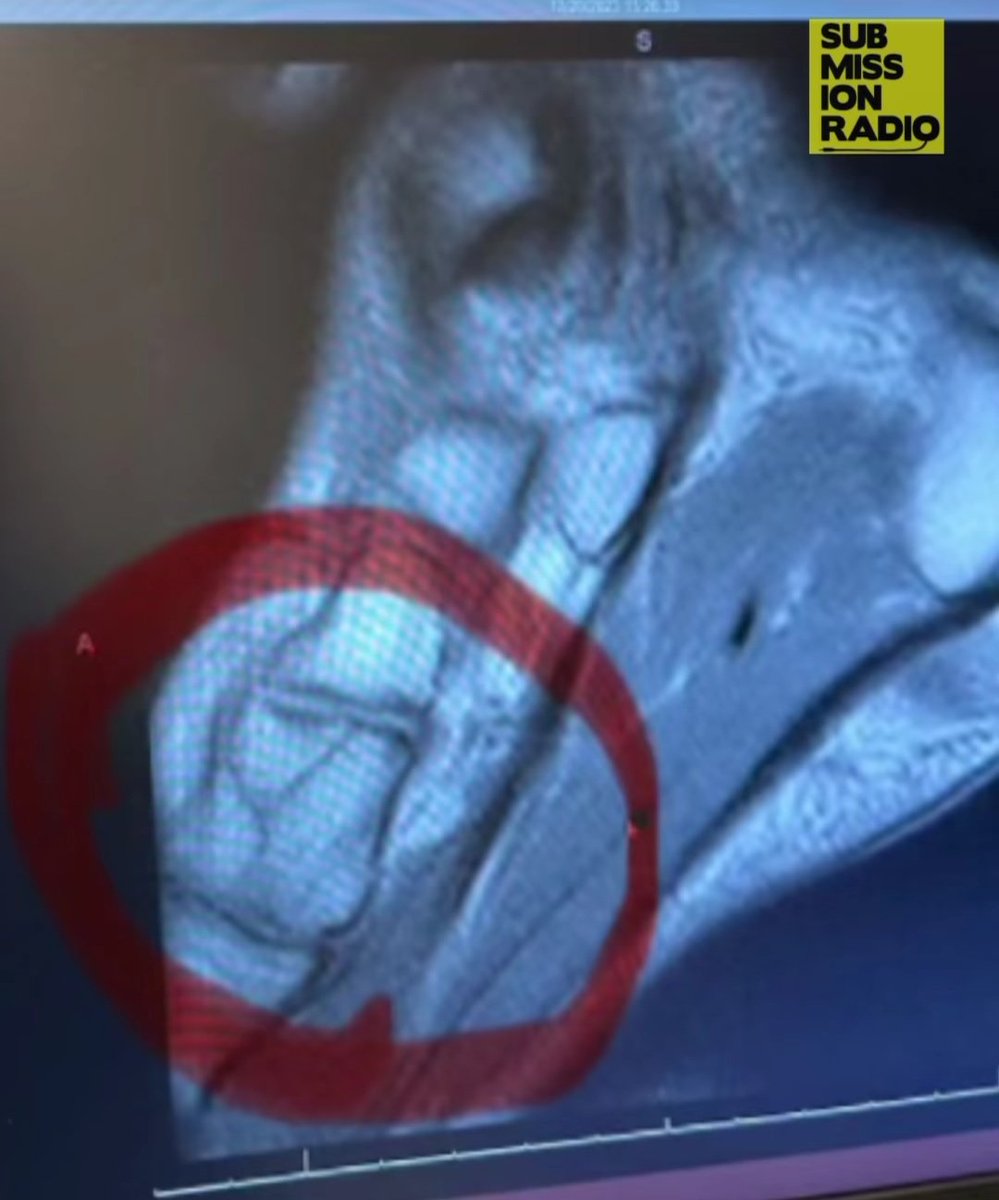 Colby Covington discloses the X-ray of his foot injury which he received in the 1st round against the fight with Leon Edwards at #UFC296

Via- Submission Radio
