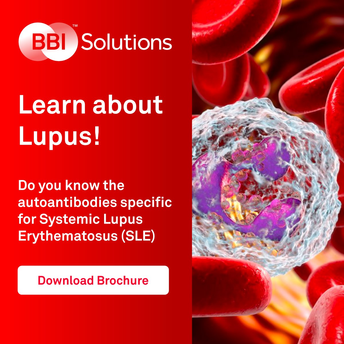 bbi_solutions's tweet image. A simple guide to the latest in Lupus testing! The BBI Solutions brochure sheds light on which antigens can be used for optimal testing and diagnosis.

Download our brochure to discover our comprehensive portfolio for Lupus autoantibody testing - loom.ly/bhbHLc8
