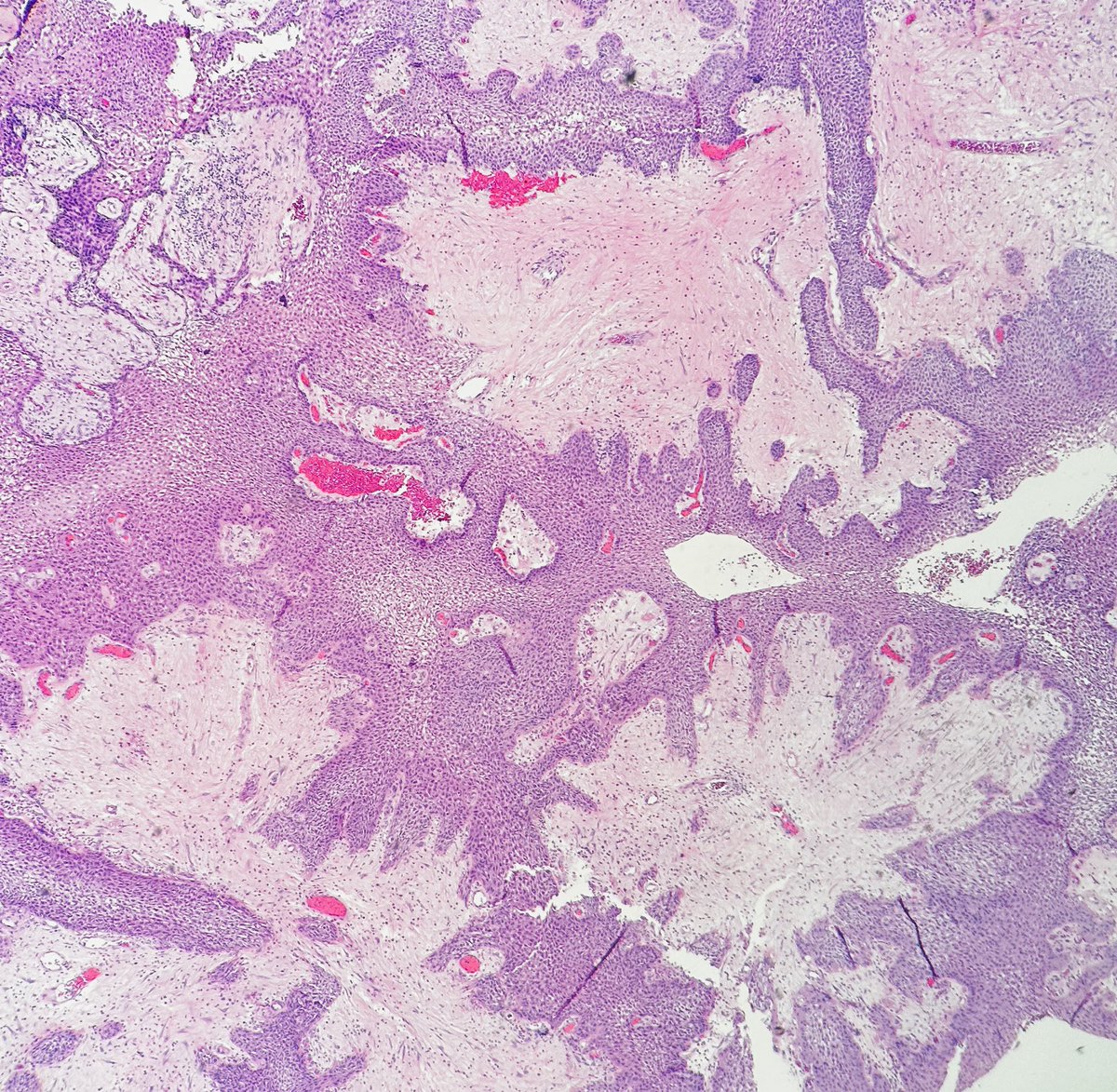 Path4People's tweet photo. Knowing the normal pattern of your stains is important. 

Beta catenin is an example. 

Normally, beta catenin is membranous. Only with Wnt activation, does it have cytoplasmic and/or nuclear staining. 

In this Papillary Craniopharyngioma, this beta catenin is “not positive” https://t.co/yvr56t8dLz