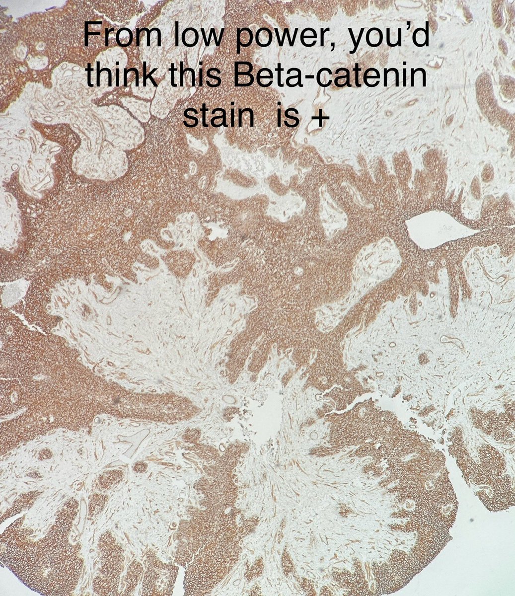 Path4People's tweet photo. Knowing the normal pattern of your stains is important. 

Beta catenin is an example. 

Normally, beta catenin is membranous. Only with Wnt activation, does it have cytoplasmic and/or nuclear staining. 

In this Papillary Craniopharyngioma, this beta catenin is “not positive” https://t.co/yvr56t8dLz