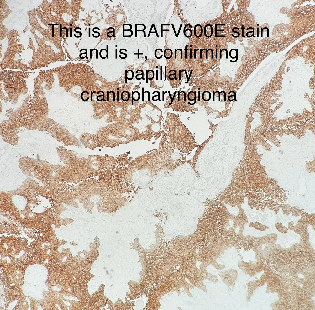Path4People's tweet photo. Knowing the normal pattern of your stains is important. 

Beta catenin is an example. 

Normally, beta catenin is membranous. Only with Wnt activation, does it have cytoplasmic and/or nuclear staining. 

In this Papillary Craniopharyngioma, this beta catenin is “not positive” https://t.co/yvr56t8dLz