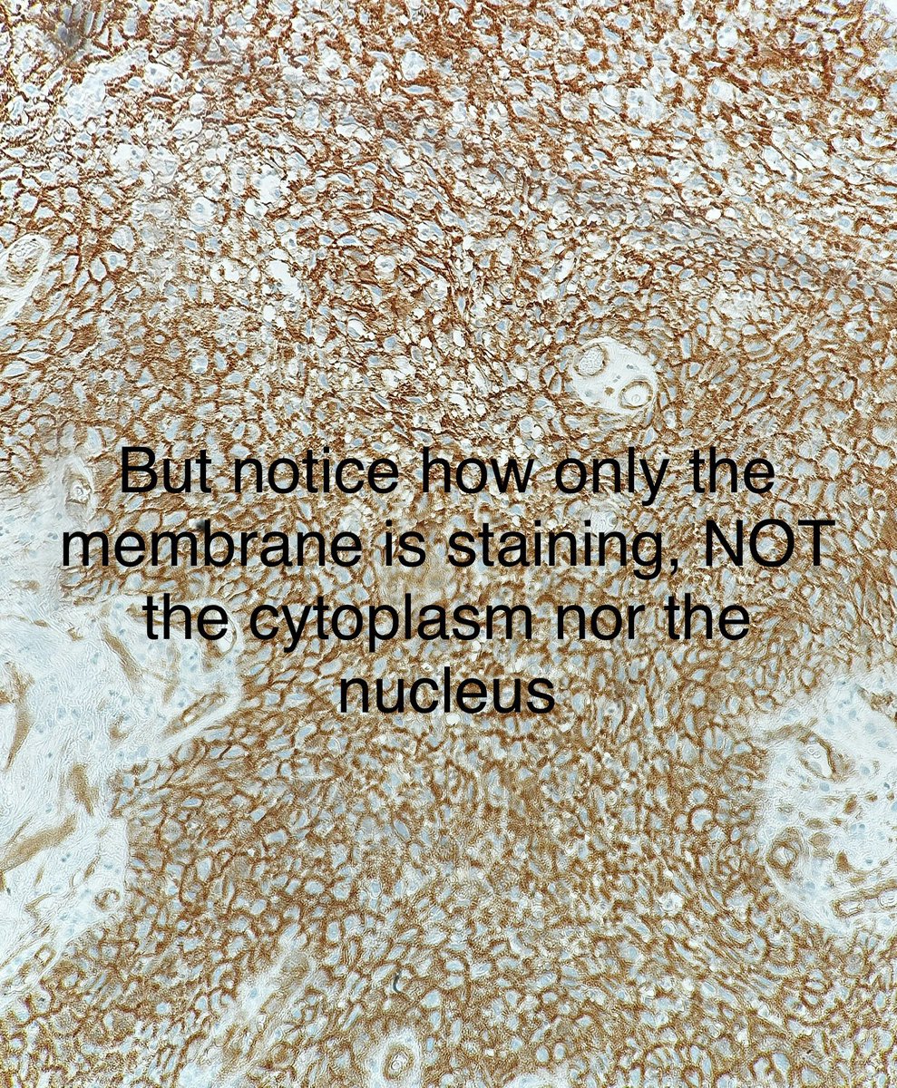 Path4People's tweet photo. Knowing the normal pattern of your stains is important. 

Beta catenin is an example. 

Normally, beta catenin is membranous. Only with Wnt activation, does it have cytoplasmic and/or nuclear staining. 

In this Papillary Craniopharyngioma, this beta catenin is “not positive” https://t.co/yvr56t8dLz