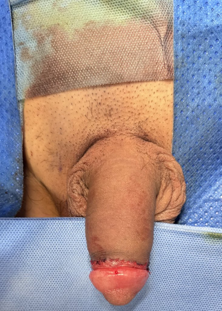 PlastiqueGEMIA's tweet photo. 包皮环切+HADM增粗+玻尿酸龟头增大 Circumcision + HADM penile augmentation + Hyaluronic Acid Glans Enlargement https://t.co/lDlB8CNezc