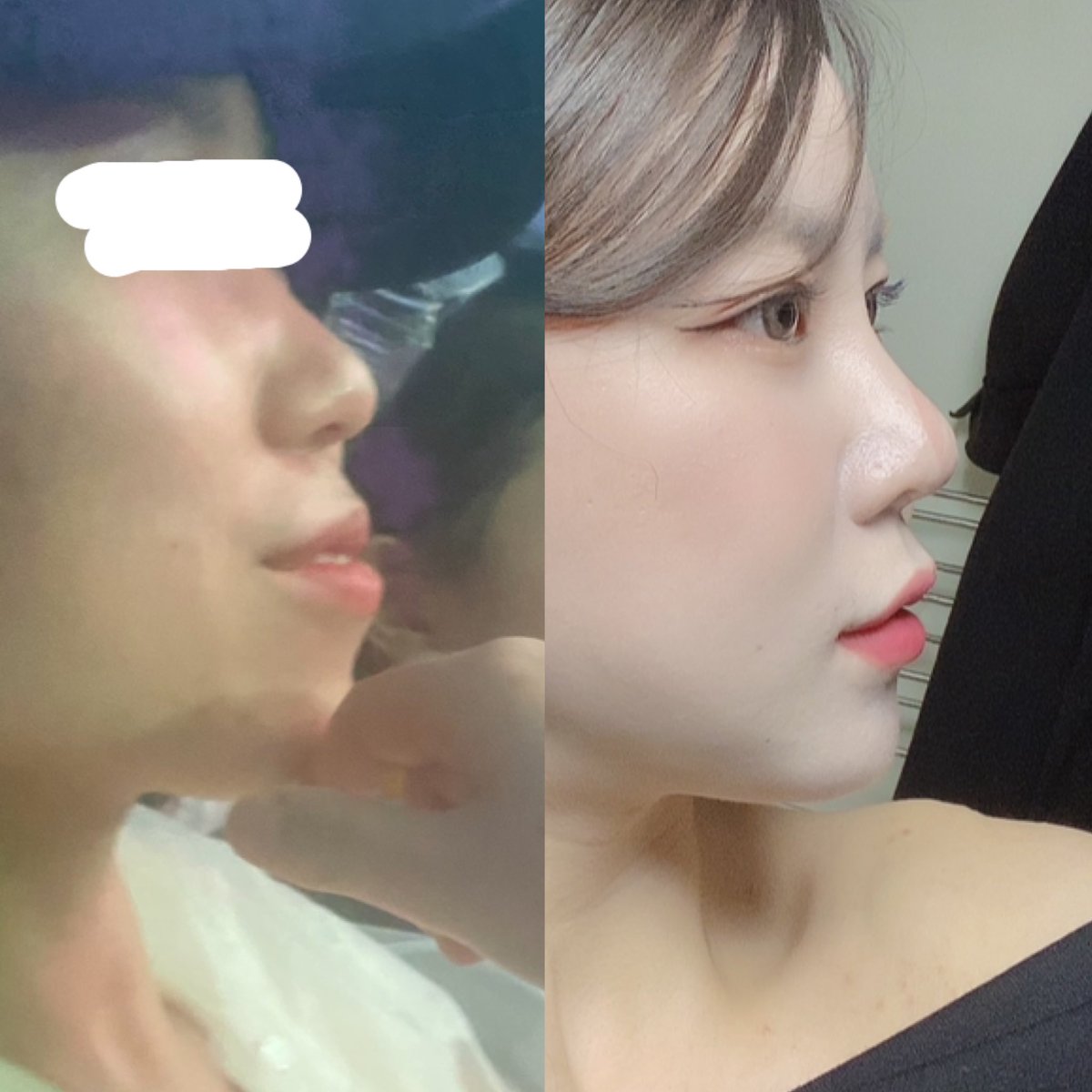 anan000807's tweet photo. 昔から横顔コンプレックスやったのに、今になってはめっちゃ色んな人に褒められるようになった🤍✨

🔹内容🔹
鼻手術/歯科矯正(抜歯8本/進行中)/輪郭3点(前顎前��)

矯正取ったらもっと口引っ込むかな🙊💕

#輪郭3点　#整形　#輪郭　#韓国整形　#骨切り https://t.co/Gre1475qPX