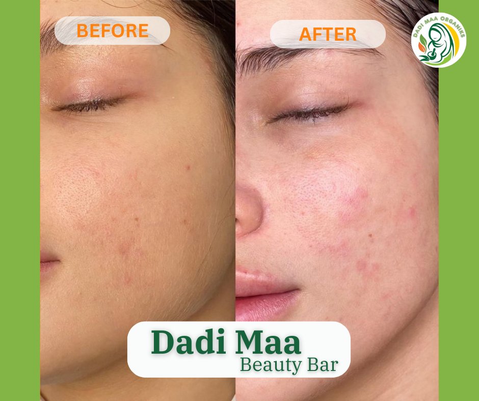 Say goodbye to acne and hello to clear, beautiful skin! Try our incredible Dadi Maa Beauty Bar today. #DadiMaaBeautyBar #AcneFighter