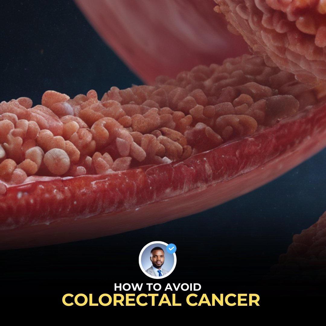 Colorectal cancers are the third-most frequent types of cancer occuring in men and women (WHO) It is also the third-most cause of cancer deaths in both sexes too Let me educate you a bit about it, and how to avoid it in your lifetime 👍🏽 🔃Repost to save someone Follow me👇🏽