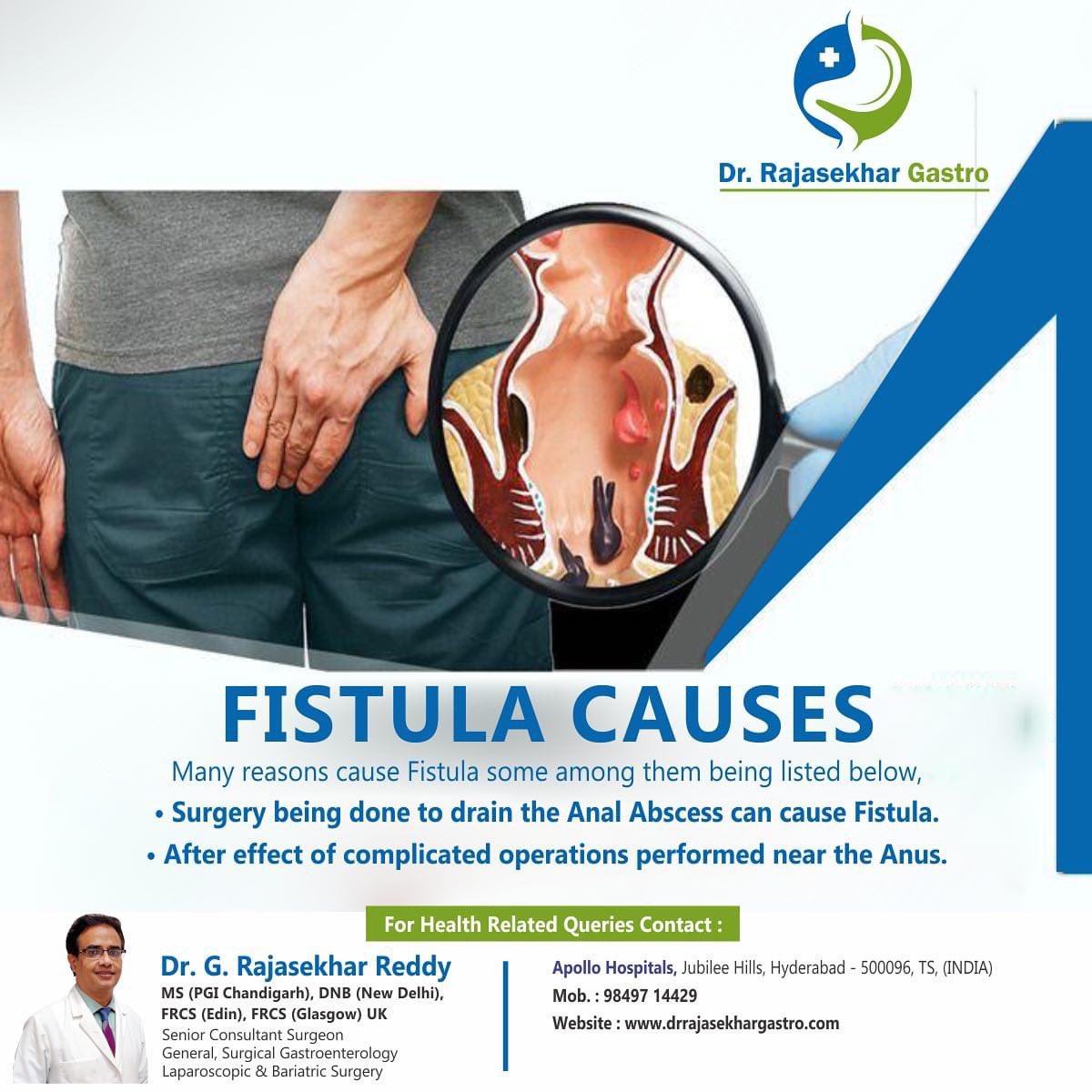 Fistula causes

Consult us now!! 

Best Fistula treatment in Hyderabad 

#DrGRajashekar #piles #pilestreatment #causes #fistulatreatment #fissuretreatment #lasertreatment #painless #procedure #nocuts #nowounds #contactus #callnow #hyderabad #gastropost #gastrosurg #gallbladder