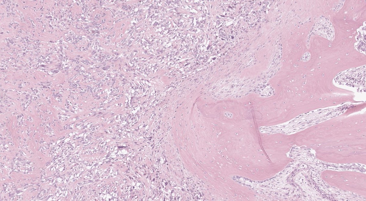 EricMadPatho's tweet photo. 54/M Below knee amputation after OSTEOSARCOMA, recurrent post-wide excision and adjuvant chemotherapy. Infiltrative evil-looking cells with atypical mitoses. #pathresident #pathX #sarcoma https://t.co/31vCsBeL83