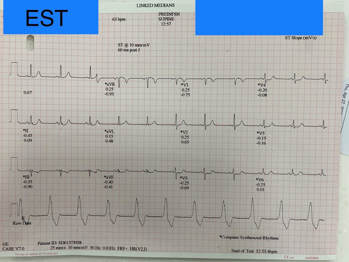 Anyone has explanation regarding the discrepancy between the raw data and the computed synthesized rhythm for this EST? #ECG #Epeeps