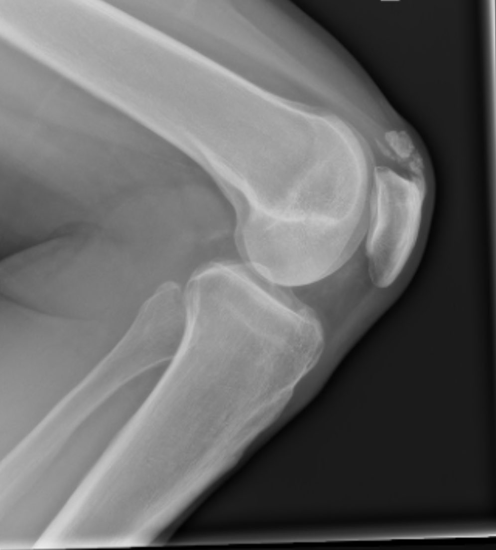 Deepu Sethi (@deepusethi) on Twitter photo Interesting case. Calcific tendonitis in distal quadriceps. Symptomatic, treatment options? <a href="/KneeUnit/">Exeter Knee Reconstruction Unit</a> <a href="/kneedoclond/">Knee Surg in London</a> <a href="/kashakhtar/">Kash Akhtar</a> <a href="/expertknee/">Raghbir Singh Khakha</a> Interesting case. Calcific tendonitis in distal quadriceps. Symptomatic, treatment options? <a href="/KneeUnit/">Exeter Knee Reconstruction Unit</a> <a href="/kneedoclond/">Knee Surg in London</a> <a href="/kashakhtar/">Kash Akhtar</a> <a href="/expertknee/">Raghbir Singh Khakha</a>