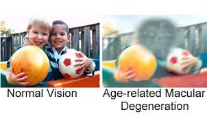 February is age-related macular degeneration awareness month.  AMD is a progressive eye disease that affects your vision, often accompanied by worsening symptoms over time.  #kendallwilsonoptometry #vision #amd #agerelatedmaculardegeneration #eyes #optometry